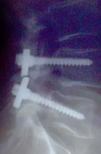 An X-ray shows the shattered pieces of a screwdriver used in a botched spinal operation on Arturo Iturralde.